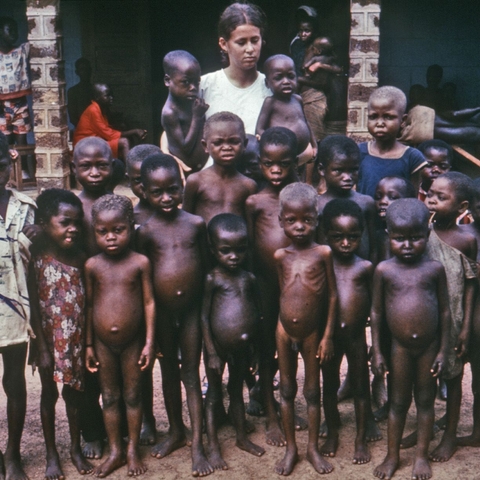 Children and a nurse at a Nigerian orphanage in the 1960s. Some of the children show signs of kwashiorkor, a protein deficiency disease