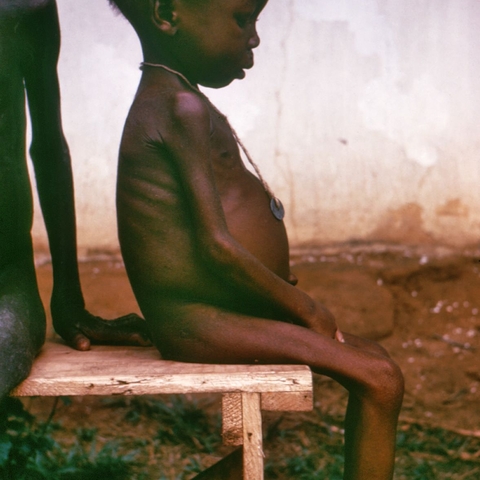 A young Nigerian child in the late 1960s suffering from a protein deficiency disease, kwashiorkor, after the Nigerian/Biafran War