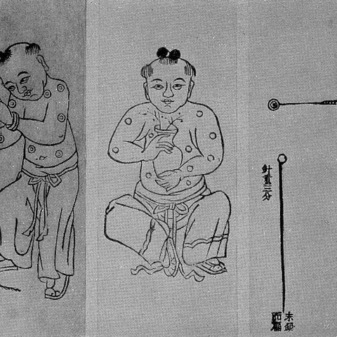 Pre-18th century Chinese vaccination method.