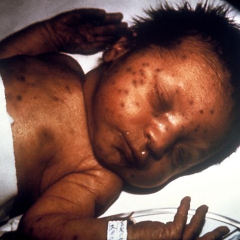 Infant in 1978 with skin lesions, indicative of hereditary rubella.