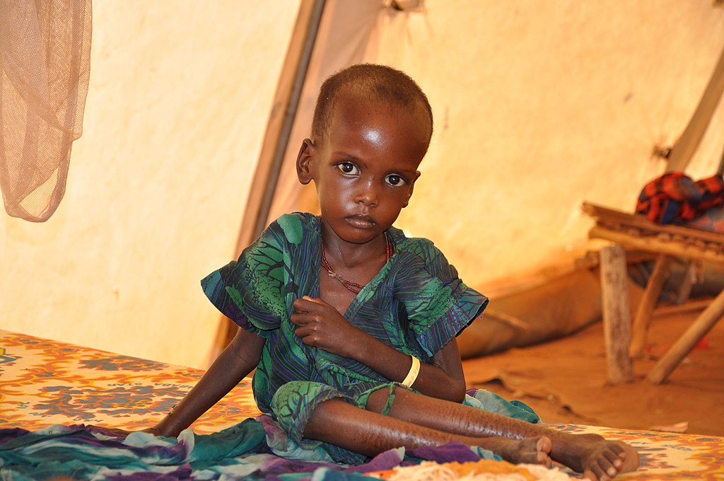 A malnourished child in a Doctors Without Borders treatment tent near Ethiopia's border with Somalia, 2011.