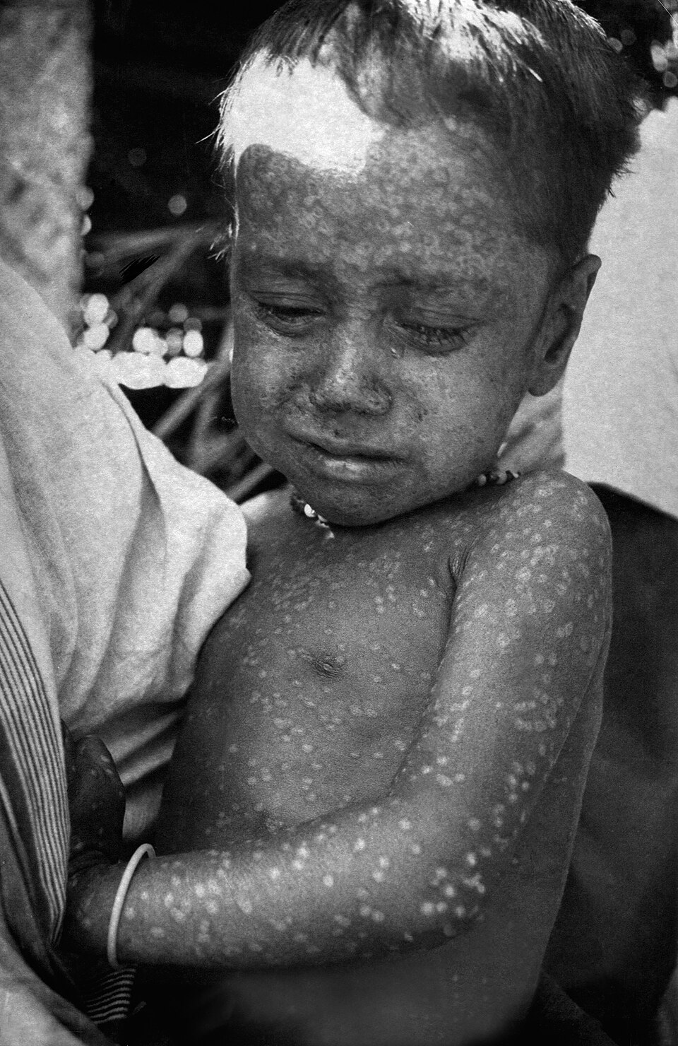 Rahima Banu, pictured here in 1975, was the last known case of naturally-occurring of smallpox in the world.