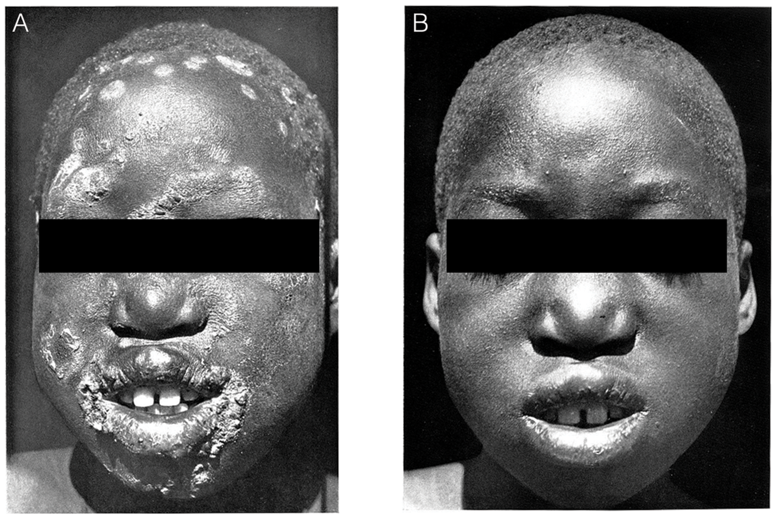 A: patient with yaws lesions on the face before treatment. B: the same patient two weeks after treatment with a single injection of benzathine penicillin.