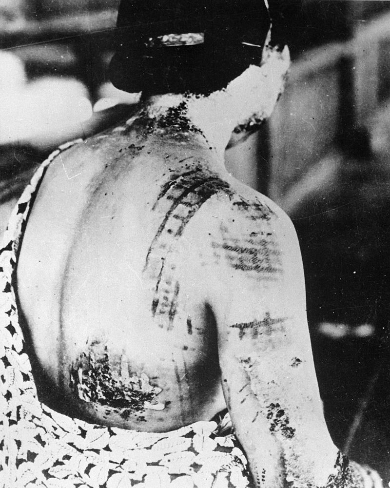 This woman's burns resulted from exposure to thermal radiation, a by-product of the blast at Hiroshima