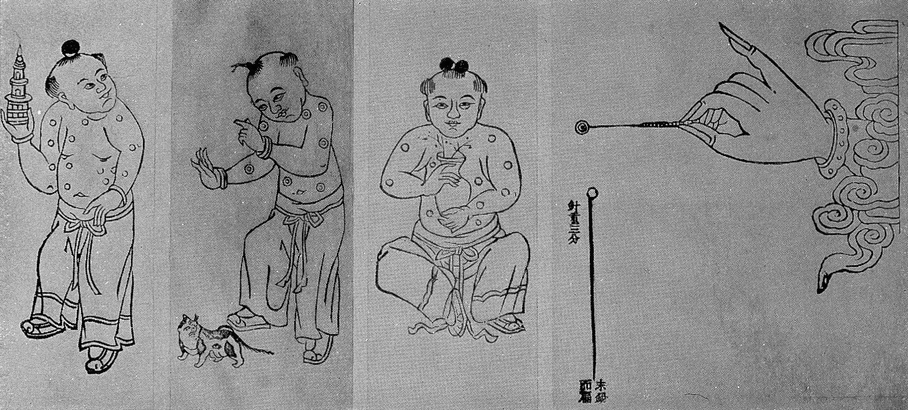 Pre-18th century Chinese vaccination method.