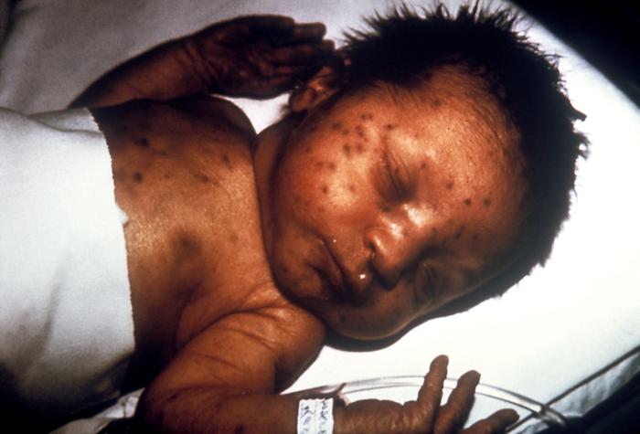 Infant in 1978 with skin lesions, indicative of hereditary rubella.