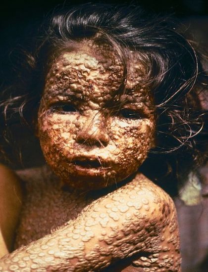 Bangladeshi girl infected with smallpox rash over her entire body in 1973.