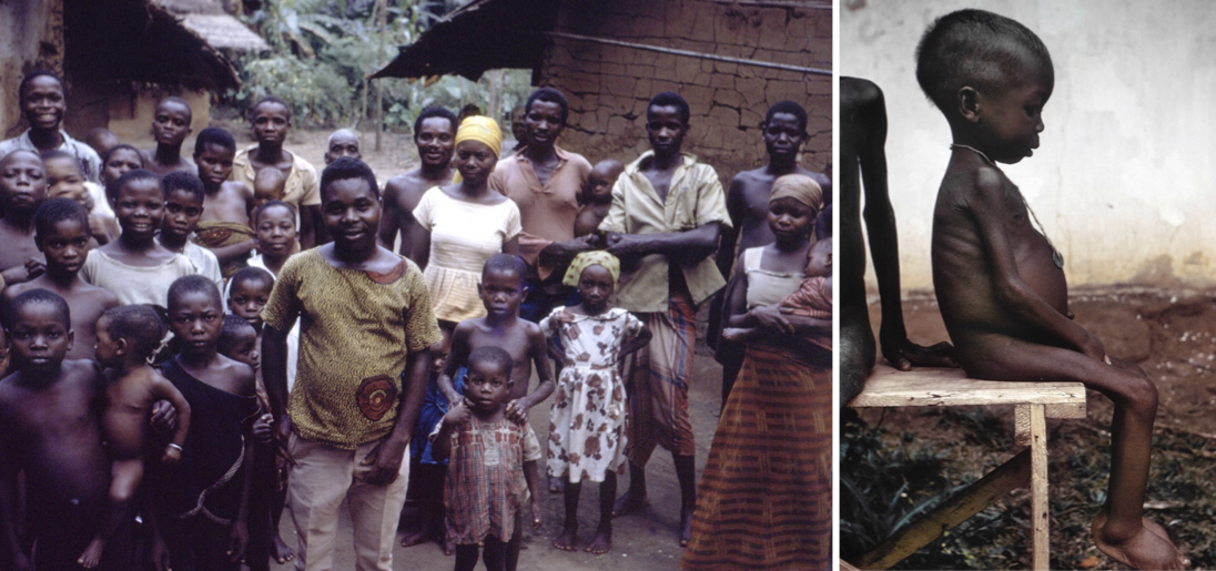 A group of refugees in Port Harcourt, 1968 (left); a Biafran child suffering the effects of starvation due to the federal blockade during the Nigerian Civil War (right)