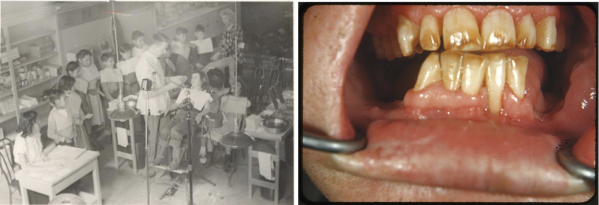 On the left, a dentist examining children’s teeth at the Pine Ridge Indian Reservation in the 1940s or 1950s. On the right, severe fluorosis, brown discoloration and mottled enamel, in an individual from an area of New Mexico with naturally occurring fluoride in the water