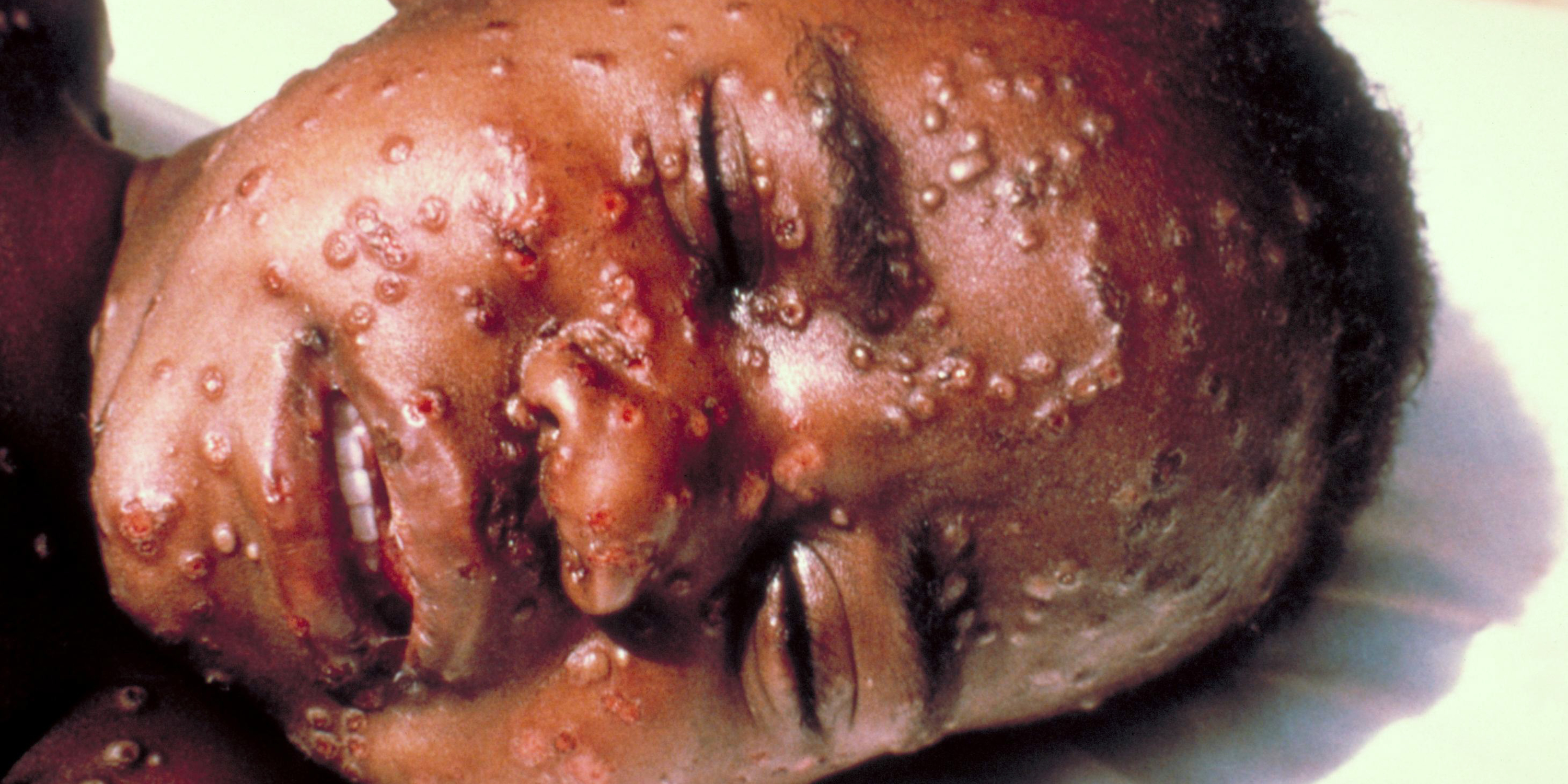 The face of a baby suffering from smallpox