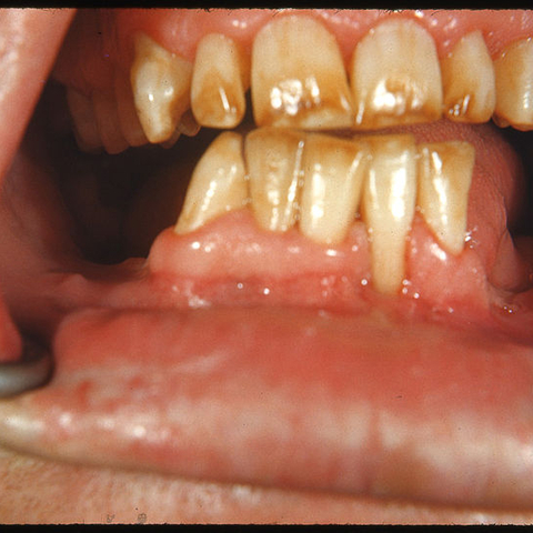 Severe fluorosis, brown discoloration and mottled enamel, in an individual from an area of New Mexico.