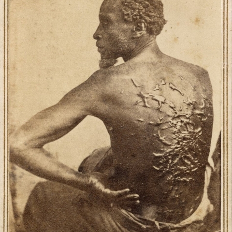Medical examination photo of Gordon showing his scourged back, widely distributed by Abolitionists to expose the brutality of slavery. From at least the 1860s onwards, photography was a powerful tool in the abolitionist movement.
