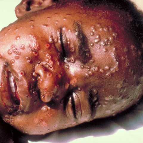 The face of a baby suffering from smallpox