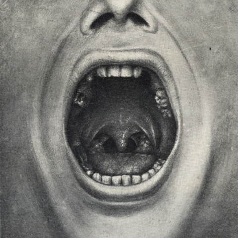 An image of removed teeth from Henry Cotton’s The Defective Delinquent and Insane (1921).