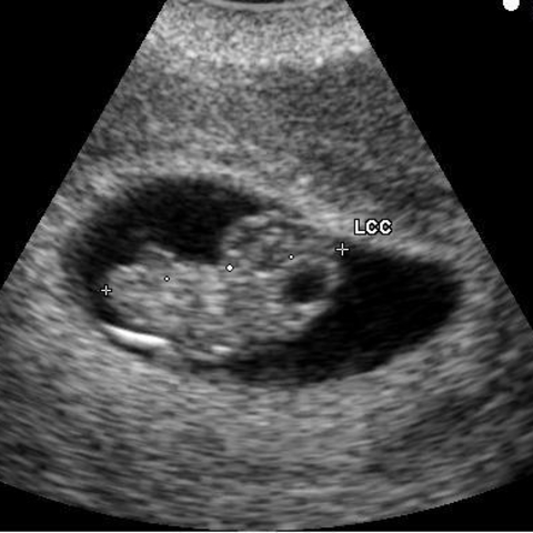 Ultrasound of an embryo at eight weeks