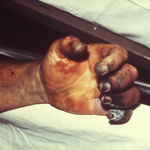 A photo from a 1975 plague victim shows necrosis of the hand.